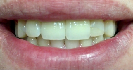 Smile with front teeth properly aligned